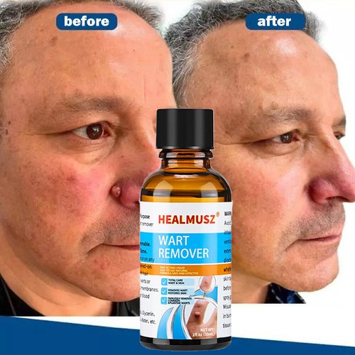 30ml wart remover - liquid, skin