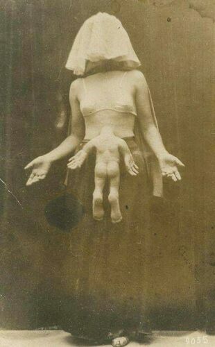 Antique medical parasitic twin - medical,