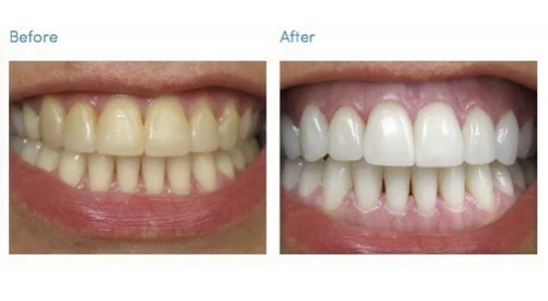 Very strong fast teeth - strong, tooth