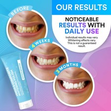 Veneer & Composite Whitening Toothpaste-Non-Abrasive Whitening Polish