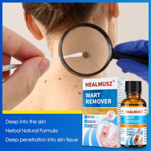 Wart remover liquid skin tag - wart,