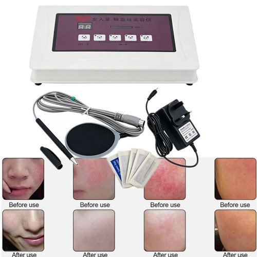 High frequency spider veins - high,