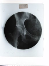 Medical X-Ray Hip Pelvis British School Osteopathy 1970s VTG Celluloid Photo