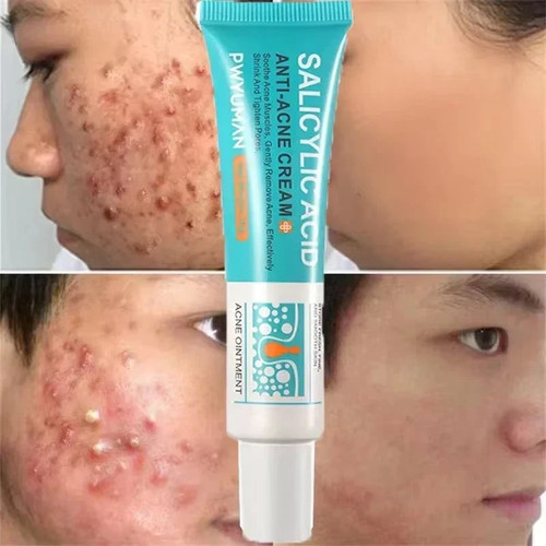 Salicylic acid strong - salicylic,