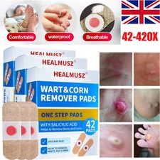 42-420 Verruca Treatment