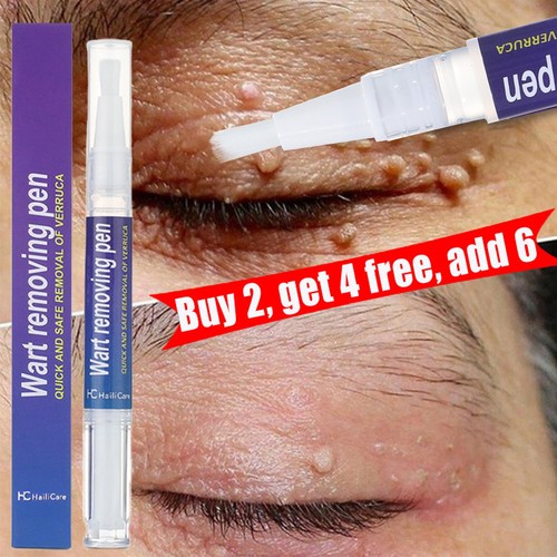 Wart remover pen skin tags - remover,