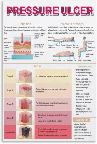 Pressure ulcer stages poster - pressure,
