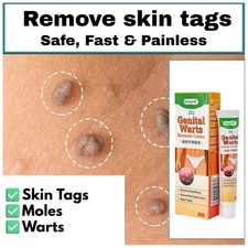 Genital Herpes Wart Remover Ointment Mole Skin Tag Acuminatum Treatment Cream