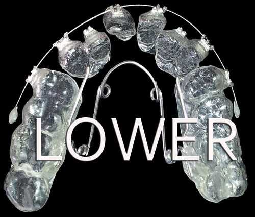 Orthodontic active retainer - orthodontic,