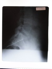 Spine X-Ray Lumbar Sacrum British School Osteopathy 1969 Medical Anatomy Photo