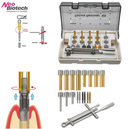 Universal implant fixture - universal,