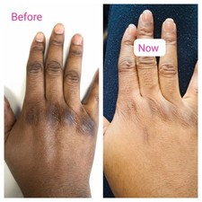 Active Dark knuckle remover