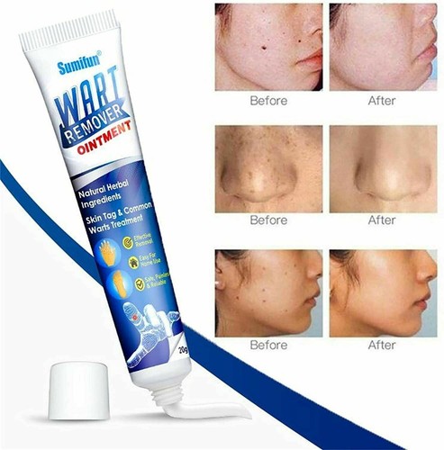Sumifun wart removal body - wart,