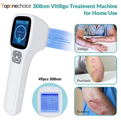Portable 308nm uvb narrowband - 308nm,