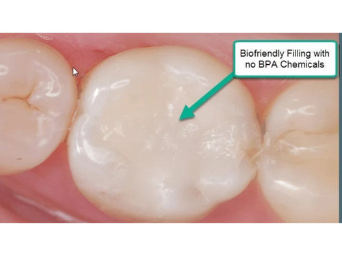 Chipped tooth filling kit diy - filling,