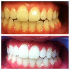 TEETH WHITENING GEL MADE IN