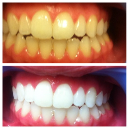 Teeth whitening gel made - gel, in