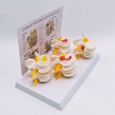 Sick Human Lumbar Model