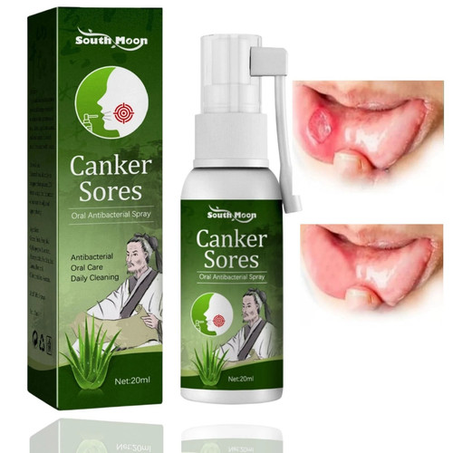 Mouth ulcer treatment - mouth,