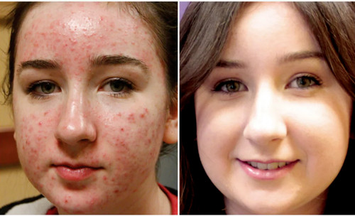 Kojic acid skin whitening - skin,