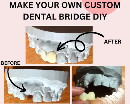 Dental bridge diy - bridge, custom