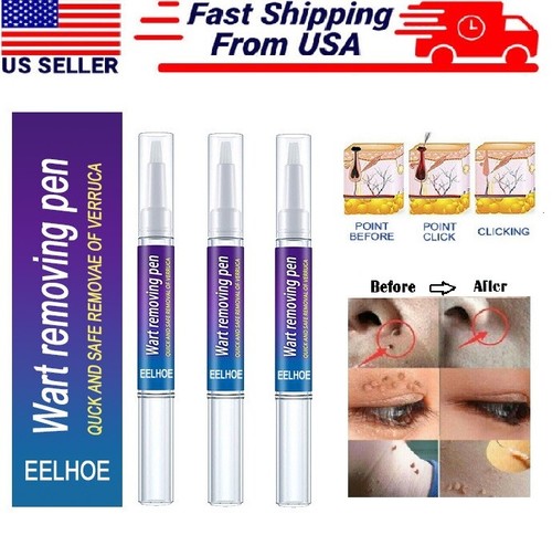 Painless wart remover - 4×,