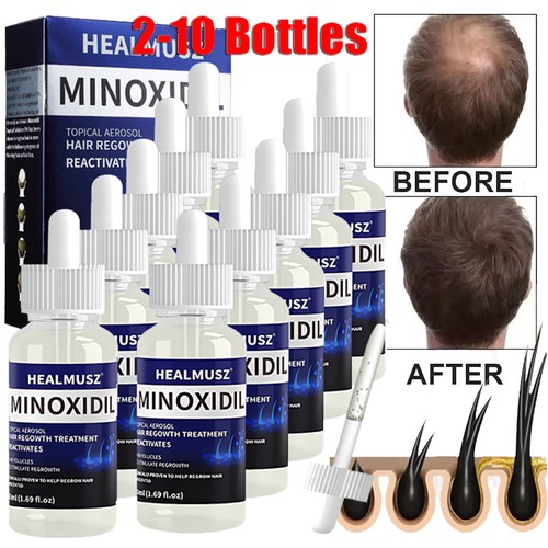 Minoxidil topical solution - topical,