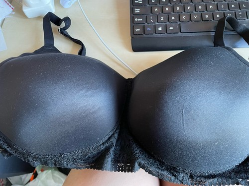 And mastectomy breast - s,