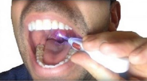 Tonsil stone remover can - stone, (can