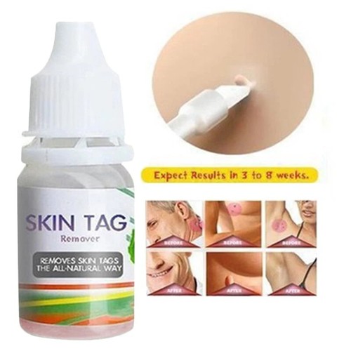 Skin tag cure removal body - removal,