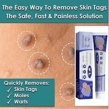 Skin Tag Mole Wart Remover Removal Cream Ointment Fast Safe Natural Treatment