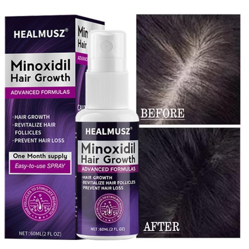Minoxidil for women hair - women,