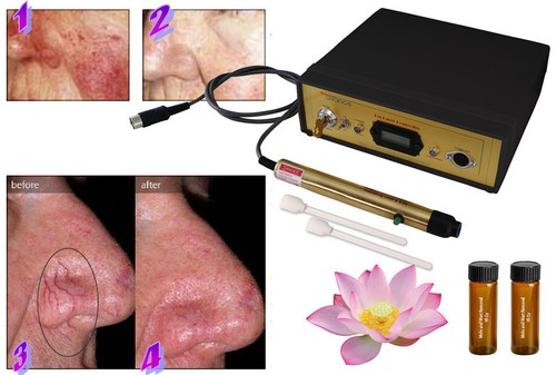 Laser spider vein capillary - laser,