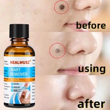 Wart Remover Fast Acting and
