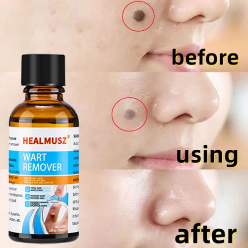 Wart remover fast acting and - fast,
