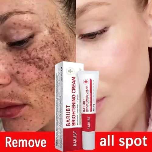 Melasma treatment dark spots - treatment,