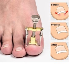 Ingrown Toenail Treatment Toe Clipper Pedicure Foot Care Correction Brace Tool