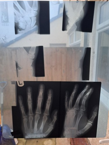 Rays human hands x 2 - of,