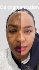 FAST Skin Whitening Bleaching