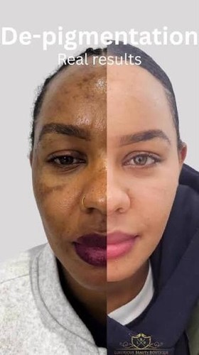 Fast skin whitening - whitening, bleaching