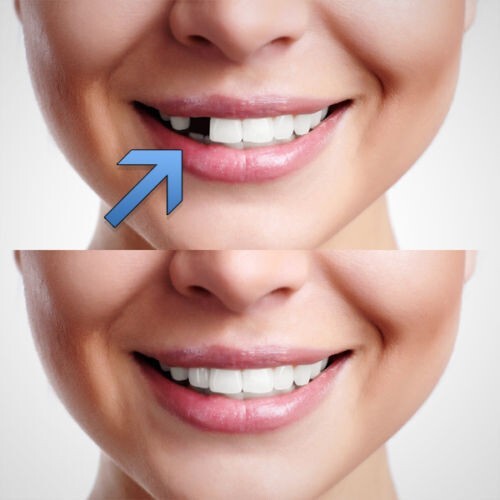 Temporary tooth repair - kit, fix