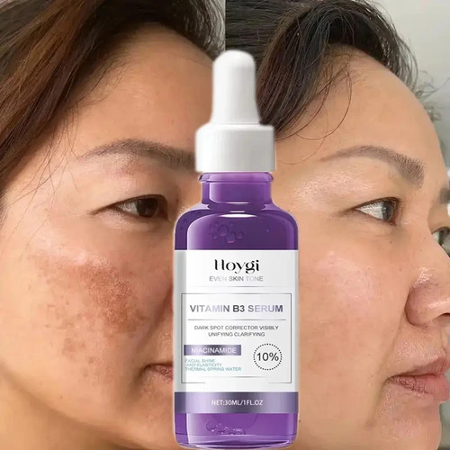 Dark spot remover - face, age