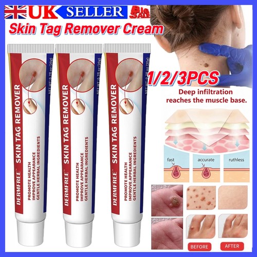 Strong skin tag remover - tag, cream