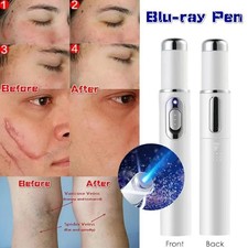 Medical Blue Light Therapy Laser Treatment Pen Acne Scar Wrinkle Removal UK
