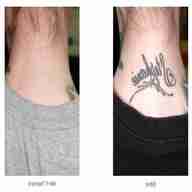 laser tattoo removal for sale