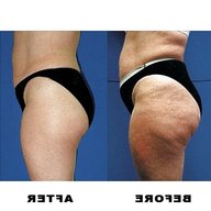 cellulite removal for sale