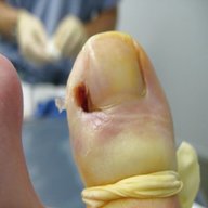 toenail for sale