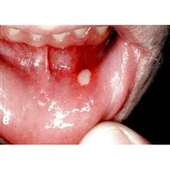 mouth ulcer for sale
