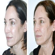 non surgical facelift for sale